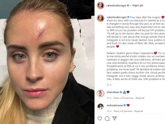 Valentina Ferragni che tumore ha avuto la sorella di Chiara