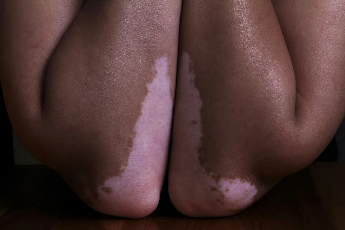 Primo piano di due ginocchia con vitiligine, che mostrano zone depigmentate su pelle scura.